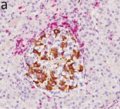 Flest T-celler lokalisert perifert Peri-insulitis, hatched bars