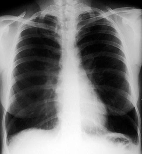 Rtg 5 Lungefibrose 8