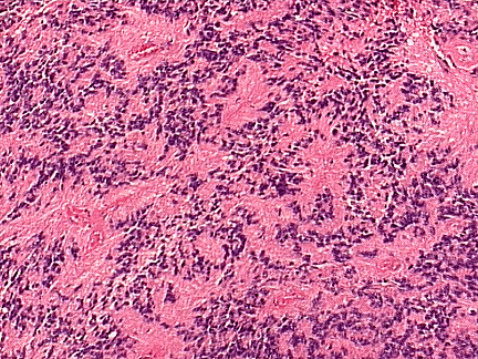 III) Pilocytisk astrocytom (WHO I) (WHOII) LAVGRADIGE SVULSTER Mikrovaskulær proliferasjon Nekroser Tromber i større kar Anaplastisk astrocytom