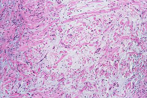 CEREBELLUM Dysembryoplastisk nevroepitelial tumor