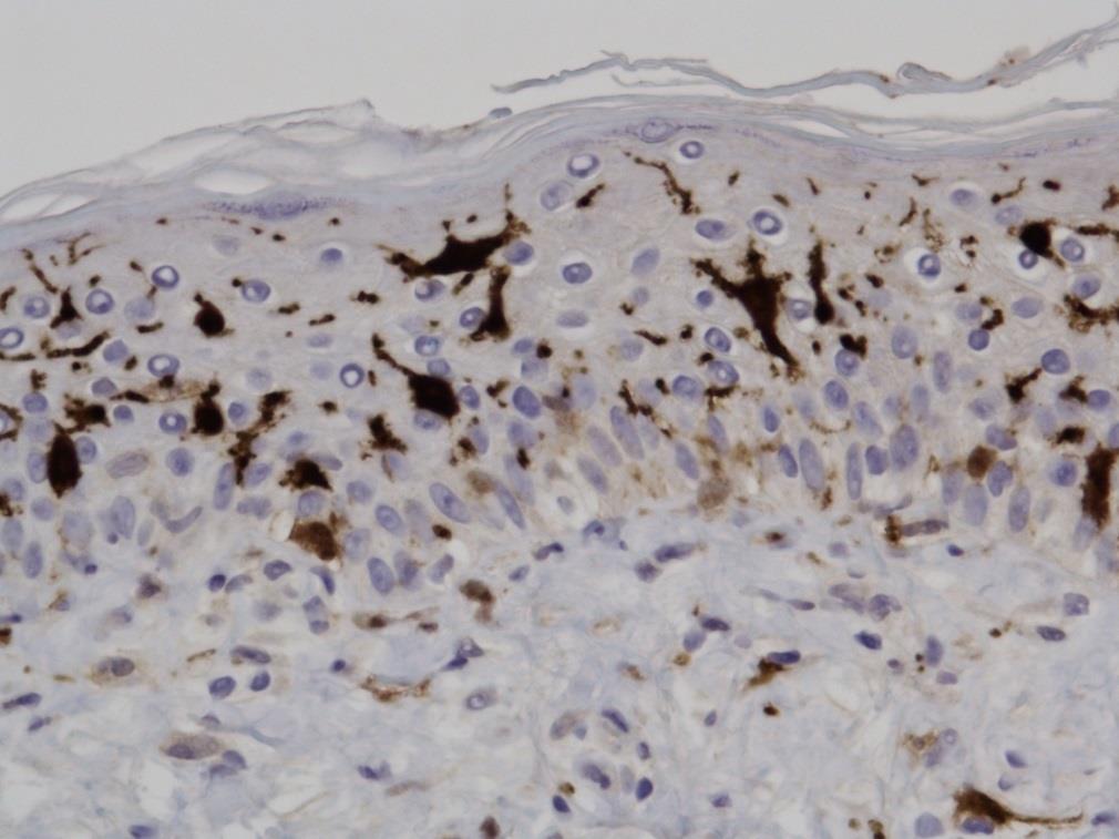 Normal Hud Langerhans celler Epidermale dendritiske celler
