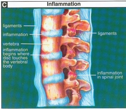 Aksial spondyloartritt Kronisk, progredierende Inflammatorisk ryggsykdom Systemisk inflammasjon, destruksjon
