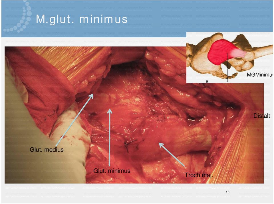 Glut. medius Glut.