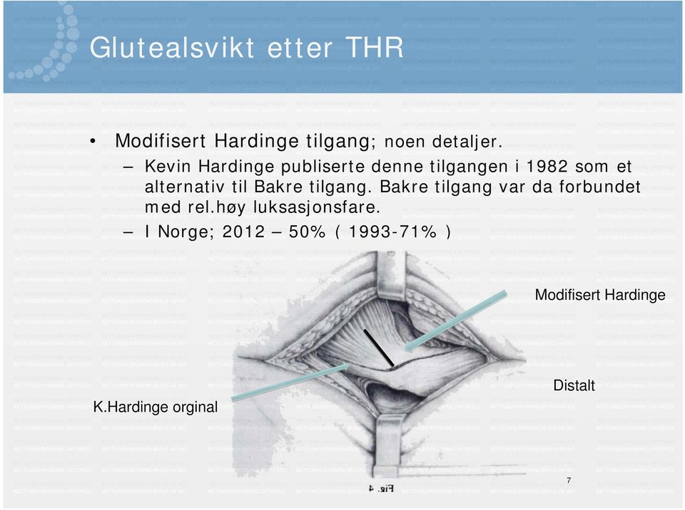 Bakre tilgang. Bakre tilgang var da forbundet med rel.høy luksasjonsfare.