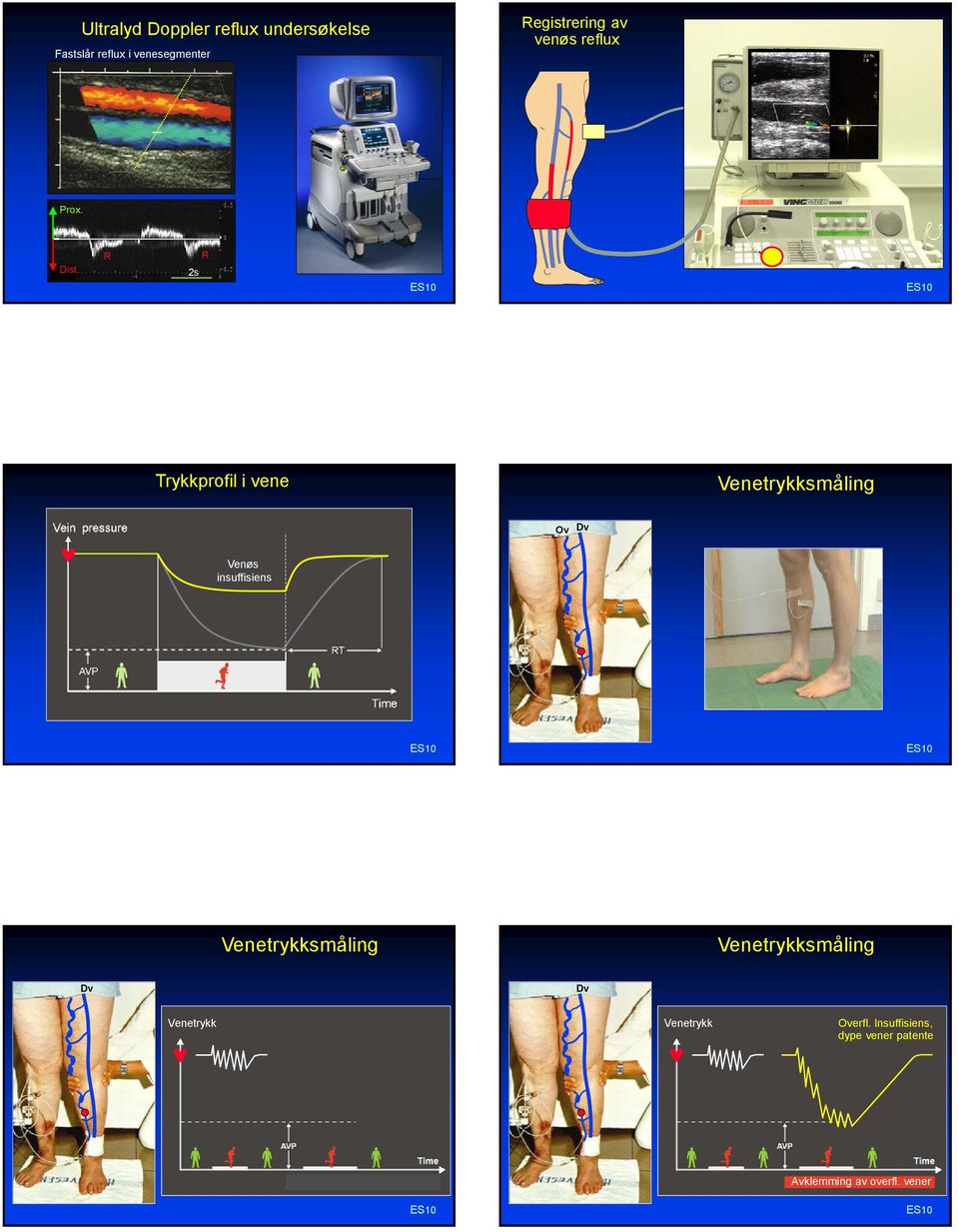 R 2s R Trykkprofil i vene Venetrykksmåling Venøs insuffisiens Ov Dv