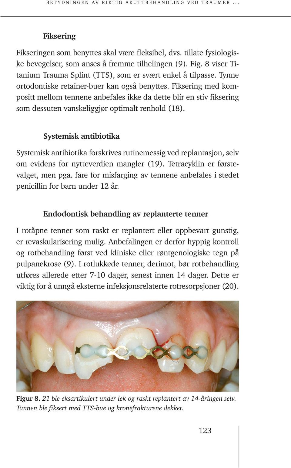 Fiksering med kompositt mellom tennene anbefales ikke da dette blir en stiv fiksering som dessuten vanskeliggjør optimalt renhold (18).
