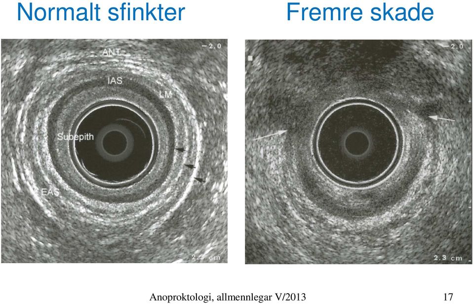 Anoproktologi,