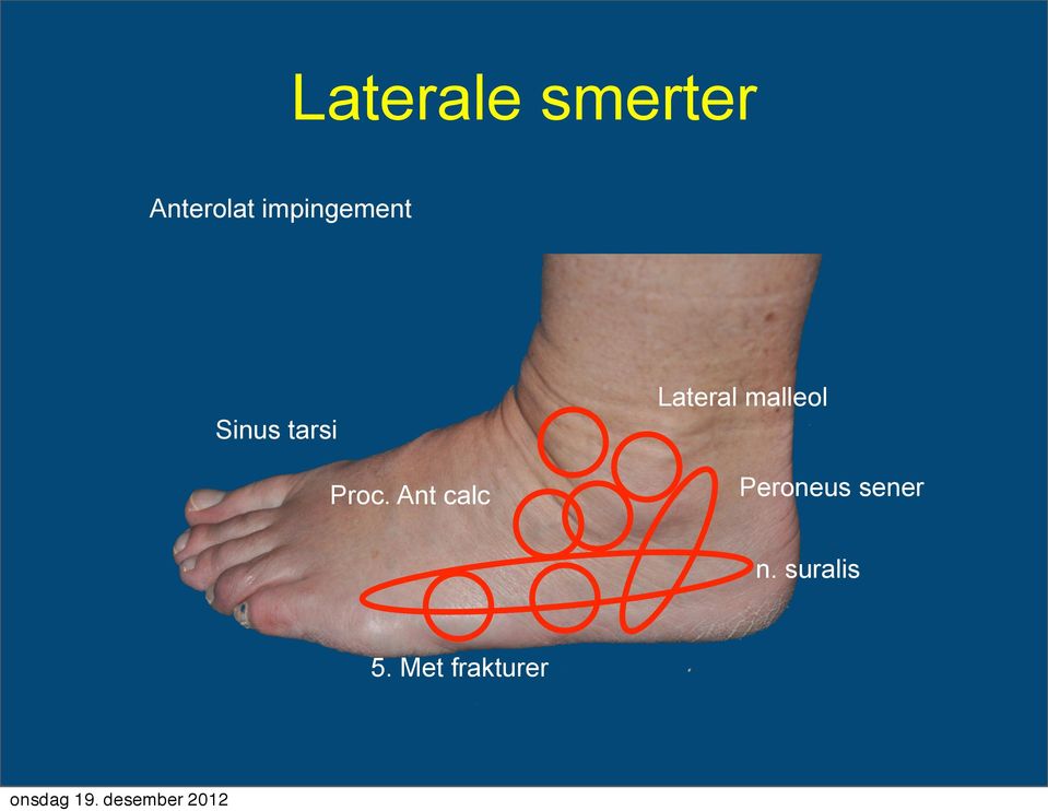 Sinus tarsi Proc.