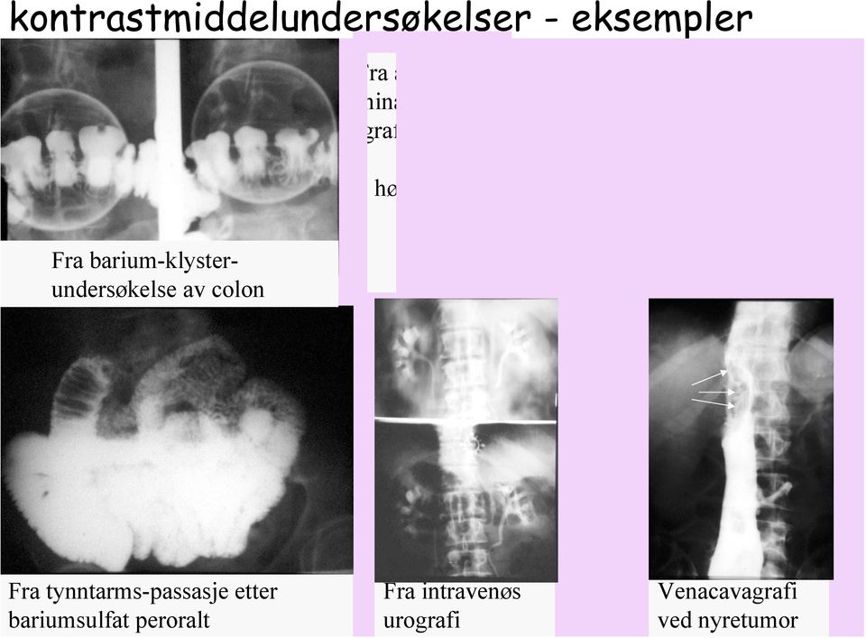 Binyretumor høyre side Fra barium-klysterundersøkelse av