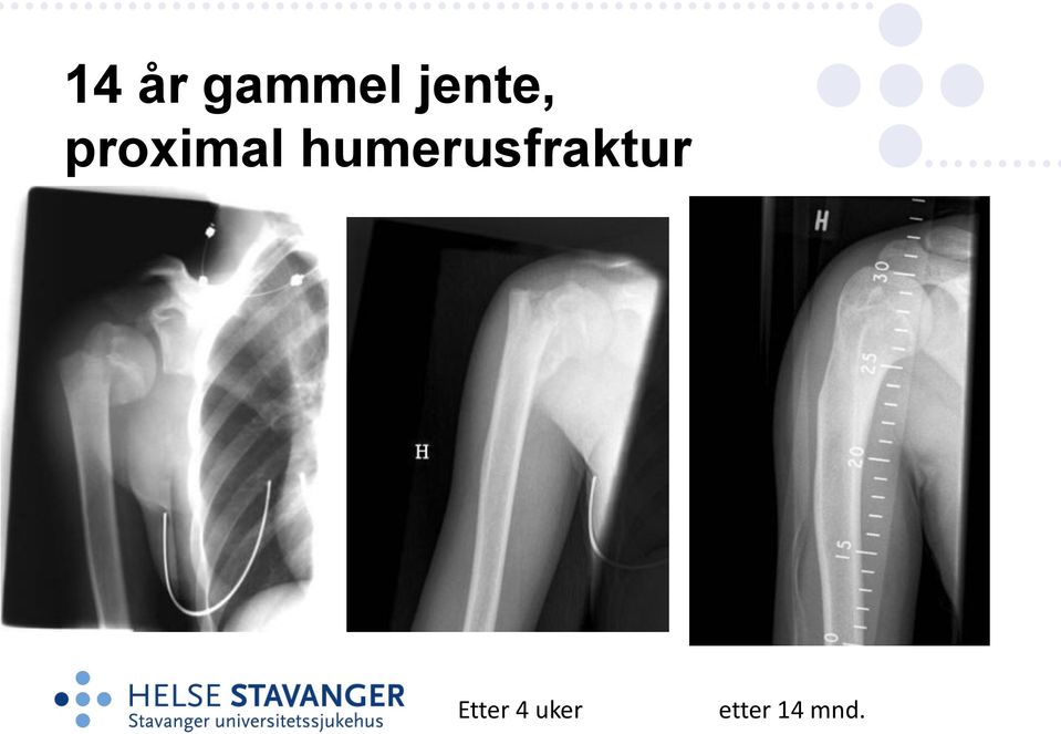 humerusfraktur