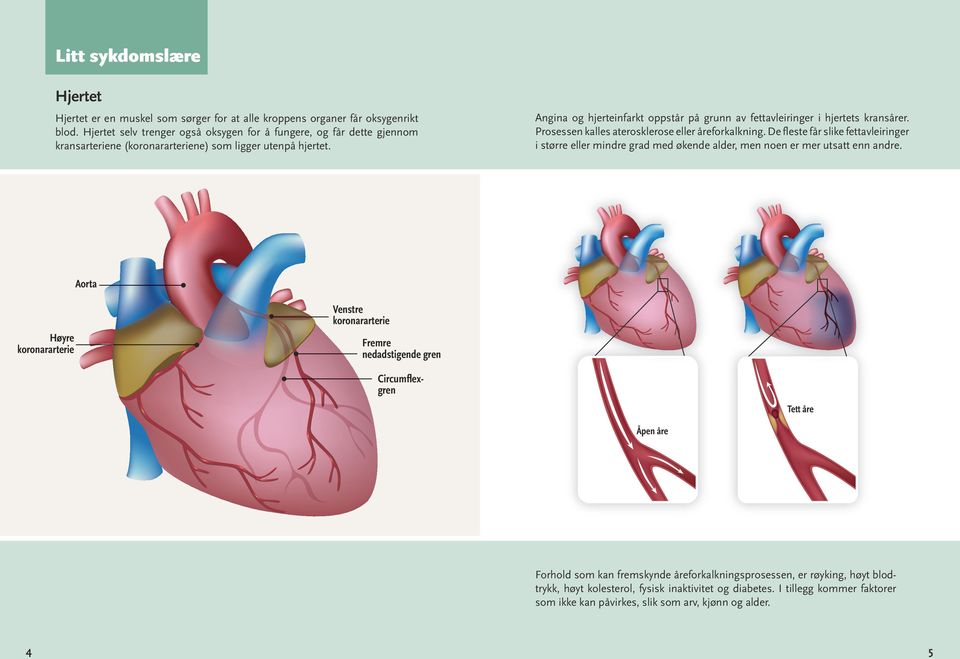 Angina og hjerteinfarkt oppstår på grunn av fettavleiringer i hjertets kransårer. Prosessen kalles aterosklerose eller åreforkalkning.