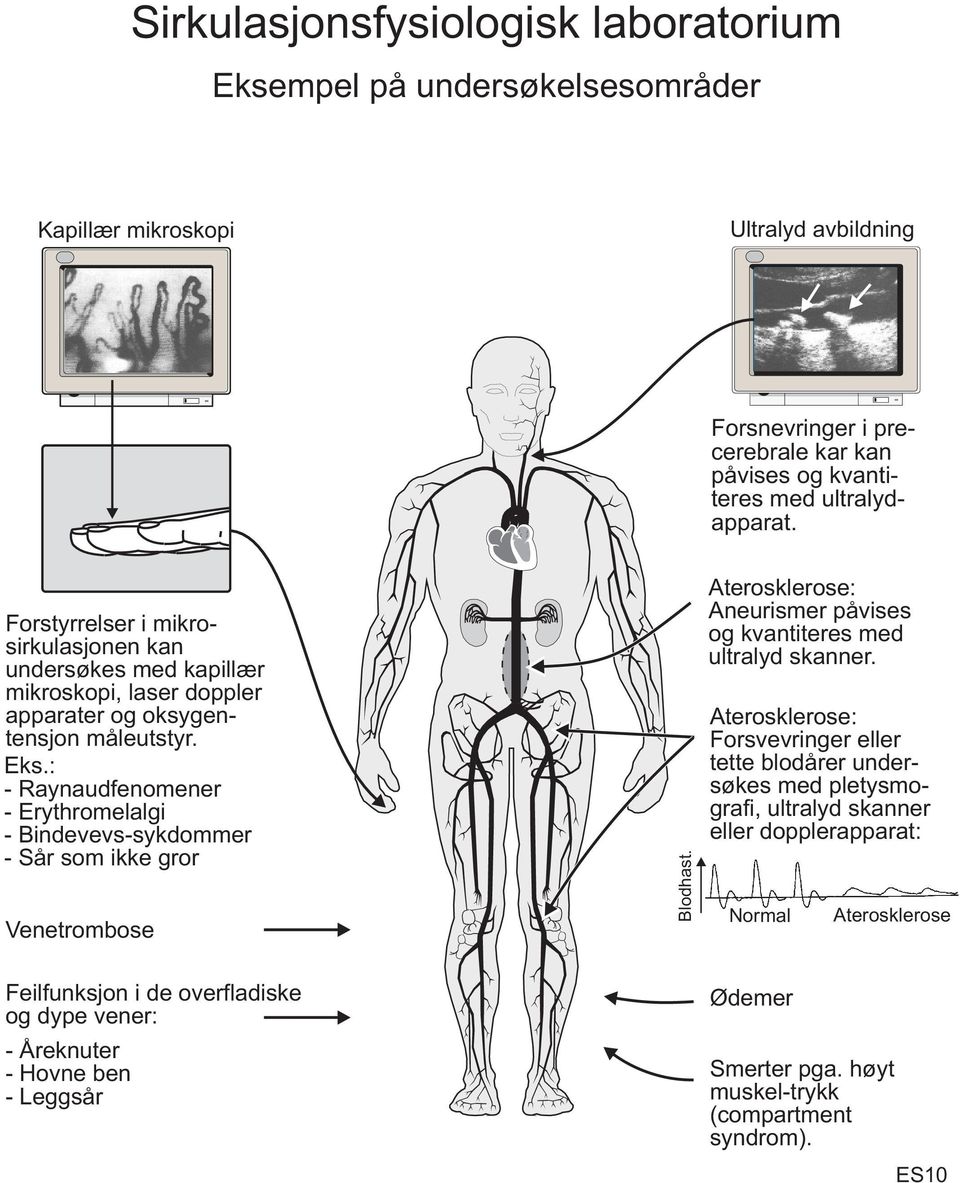 : - Raynaudfenomener - Erythromelalgi - Bindevevs-sykdommer - Sår som ikke gror Venetrombose Blodhast. Aterosklerose: Aneurismer påvises og kvantiteres med ultralyd skanner.