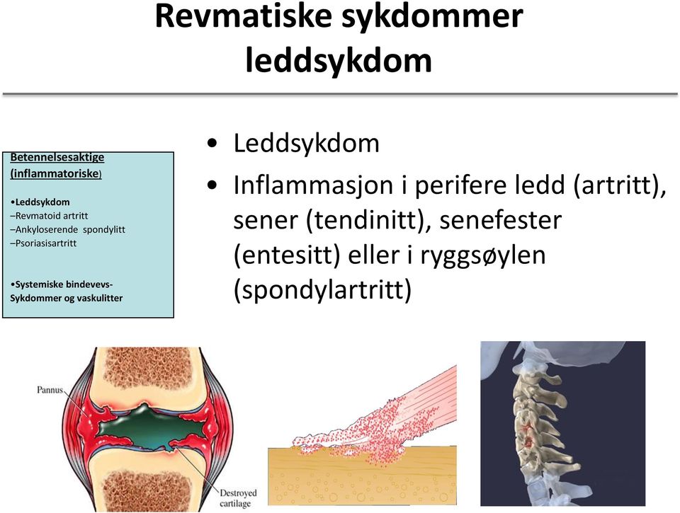 bindevevs- Sykdommer og vaskulitter Leddsykdom Inflammasjon i perifere ledd