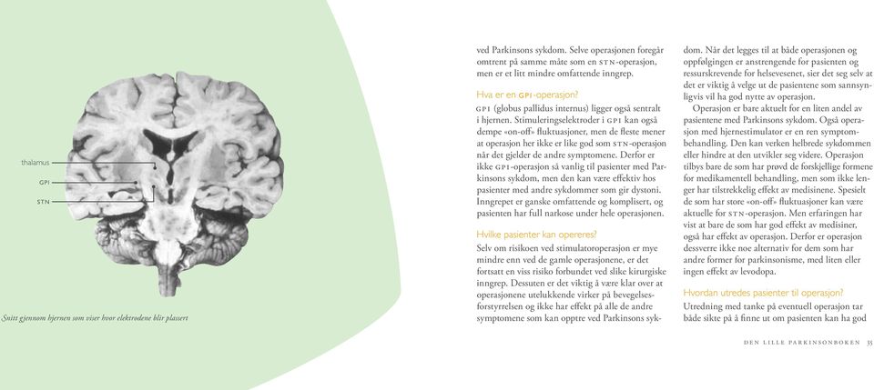 GPI (globus pallidus internus) ligger også sentralt i hjernen.