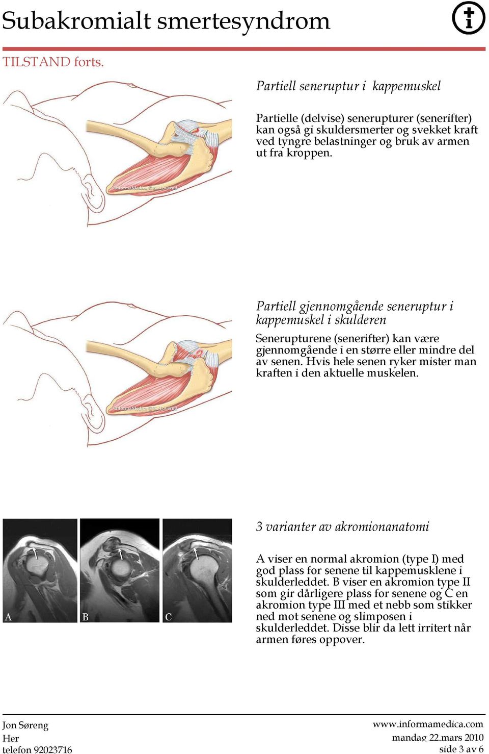 Partiell gjennomgående seneruptur i kappemuskel i skulderen Senerupturene (senerifter) kan være gjennomgående i en større eller mindre del av senen.