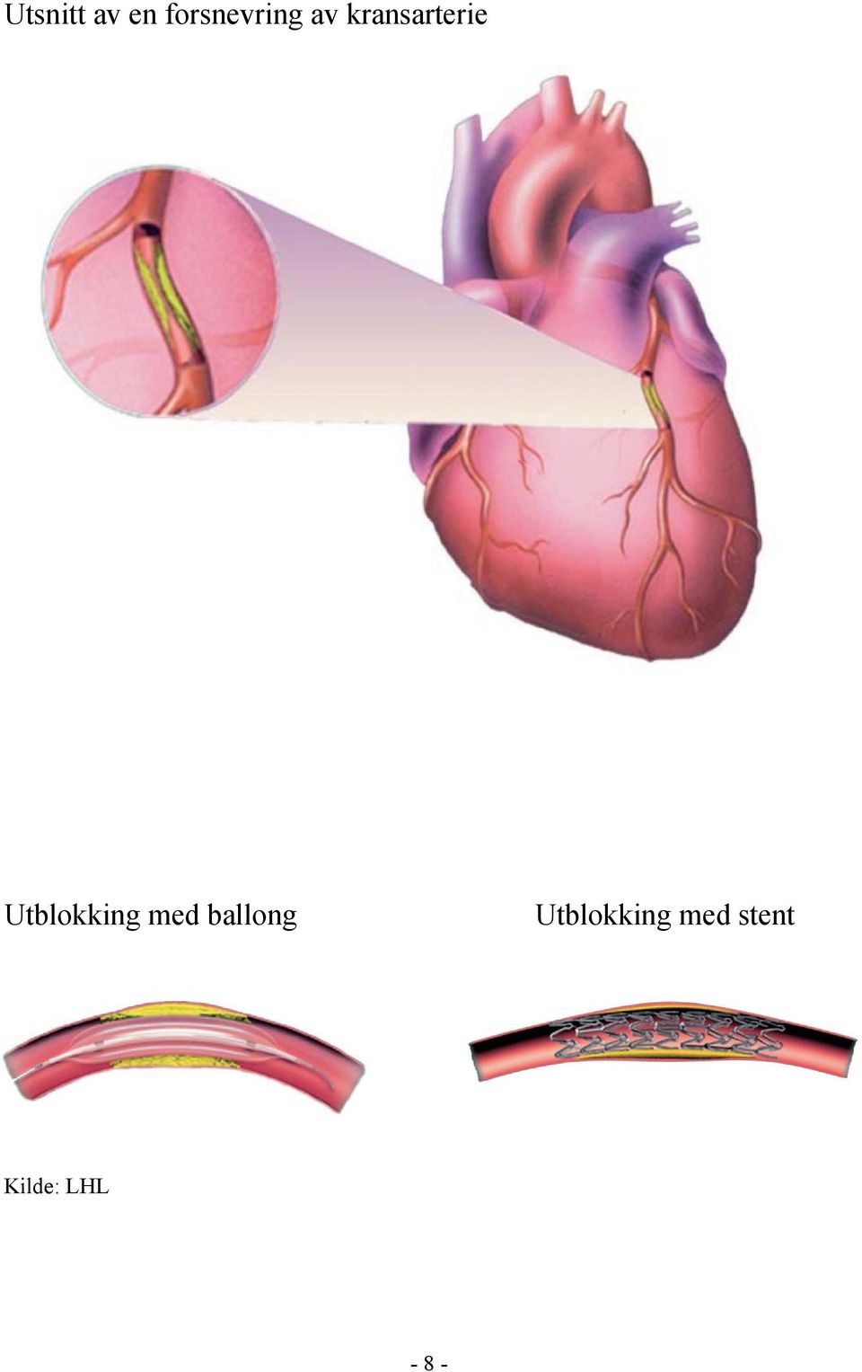 Utblokking med ballong