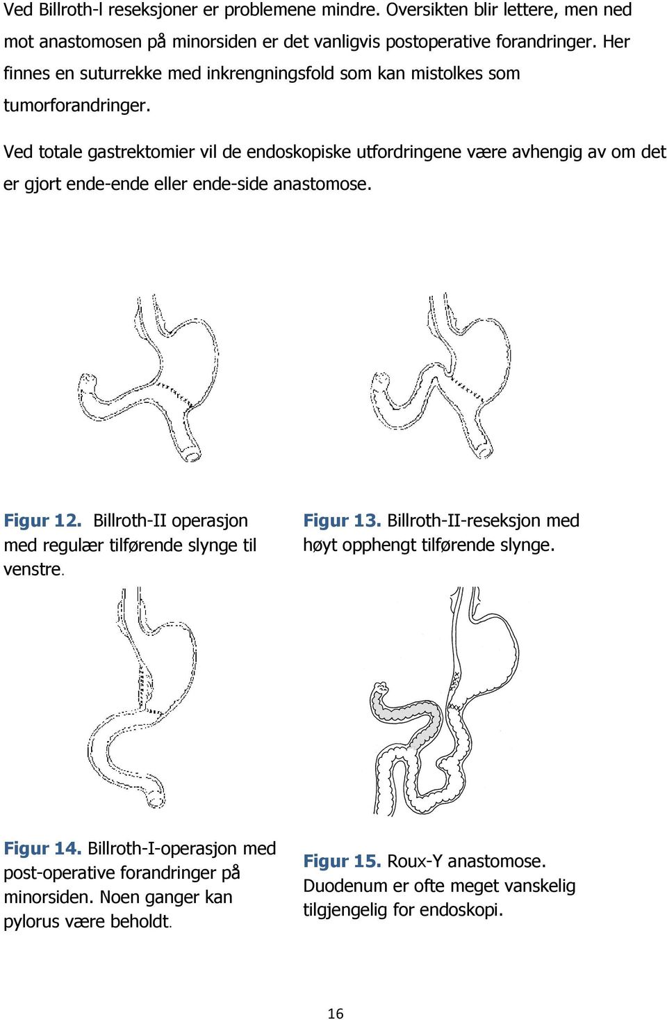Ved totale gastrektomier vil de endoskopiske utfordringene være avhengig av om det er gjort ende-ende eller ende-side anastomose. Figur 12.