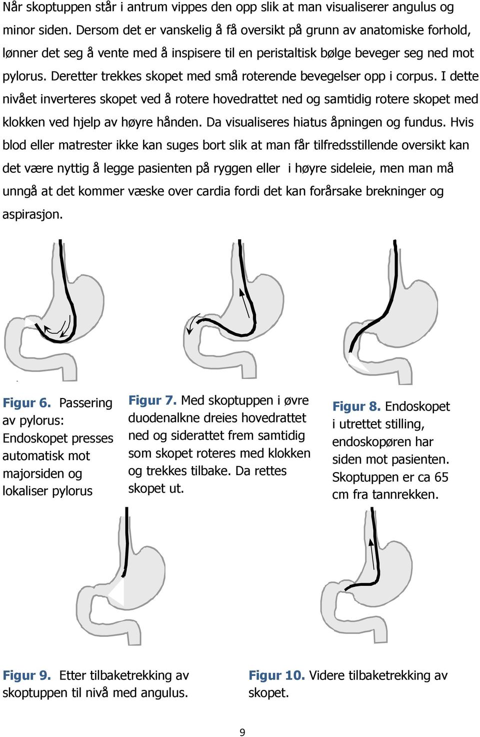 Deretter trekkes skopet med små roterende bevegelser opp i corpus. I dette nivået inverteres skopet ved å rotere hovedrattet ned og samtidig rotere skopet med klokken ved hjelp av høyre hånden.