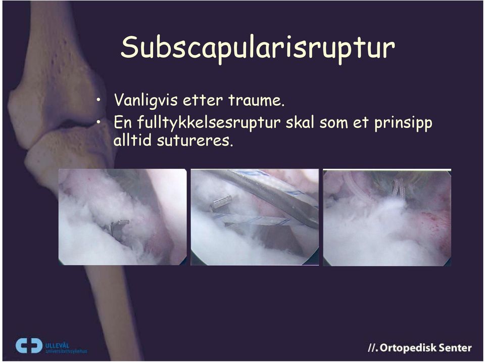 En fulltykkelsesruptur