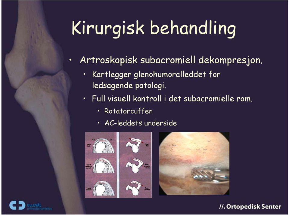 Kartlegger glenohumoralleddet for ledsagende