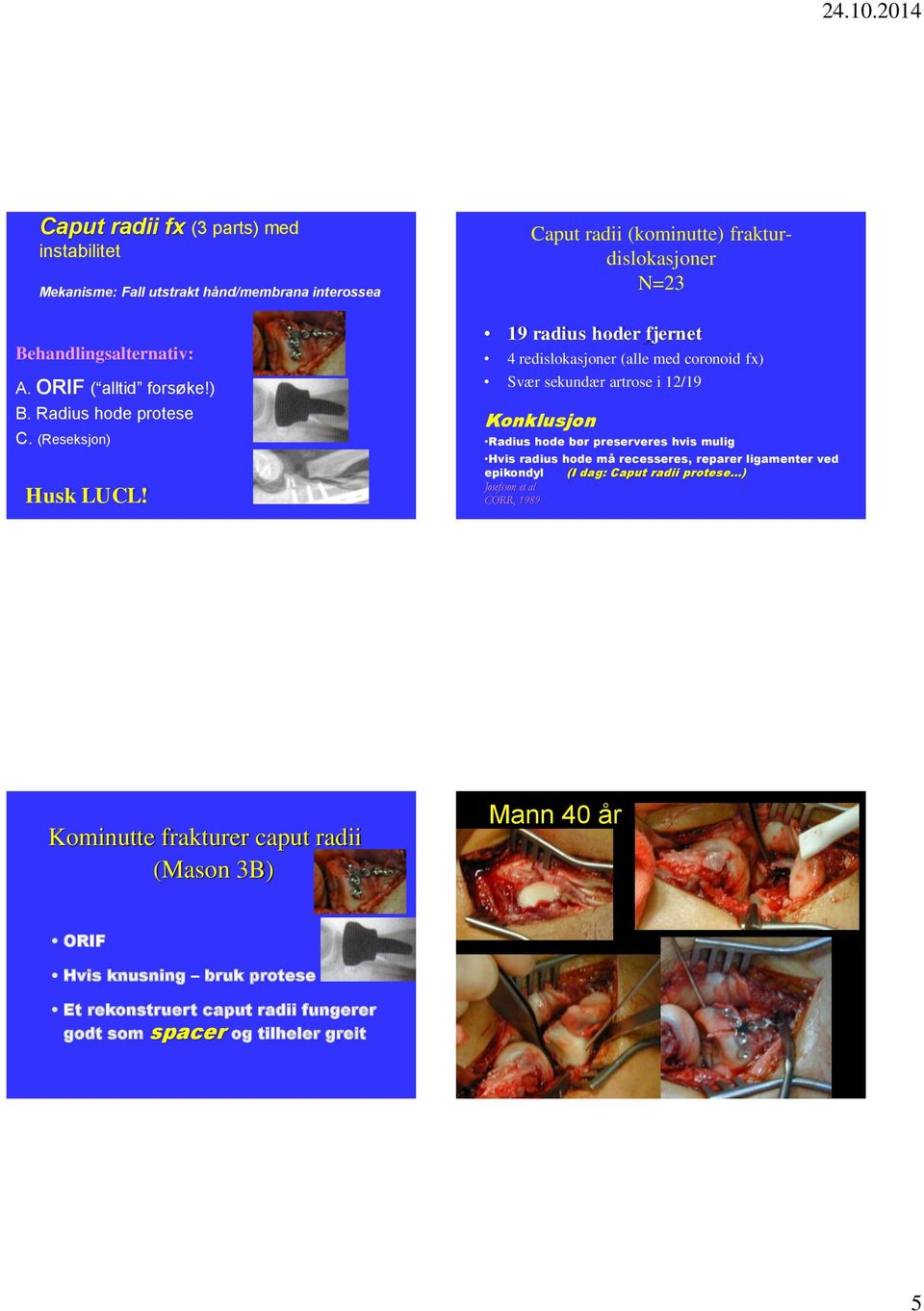 19 radius hoder fjernet 4 redislokasjoner (alle med coronoid fx) Svær sekundær artrose i 12/19 Konklusjon Radius hode bør preserveres hvis mulig Hvis radius hode må