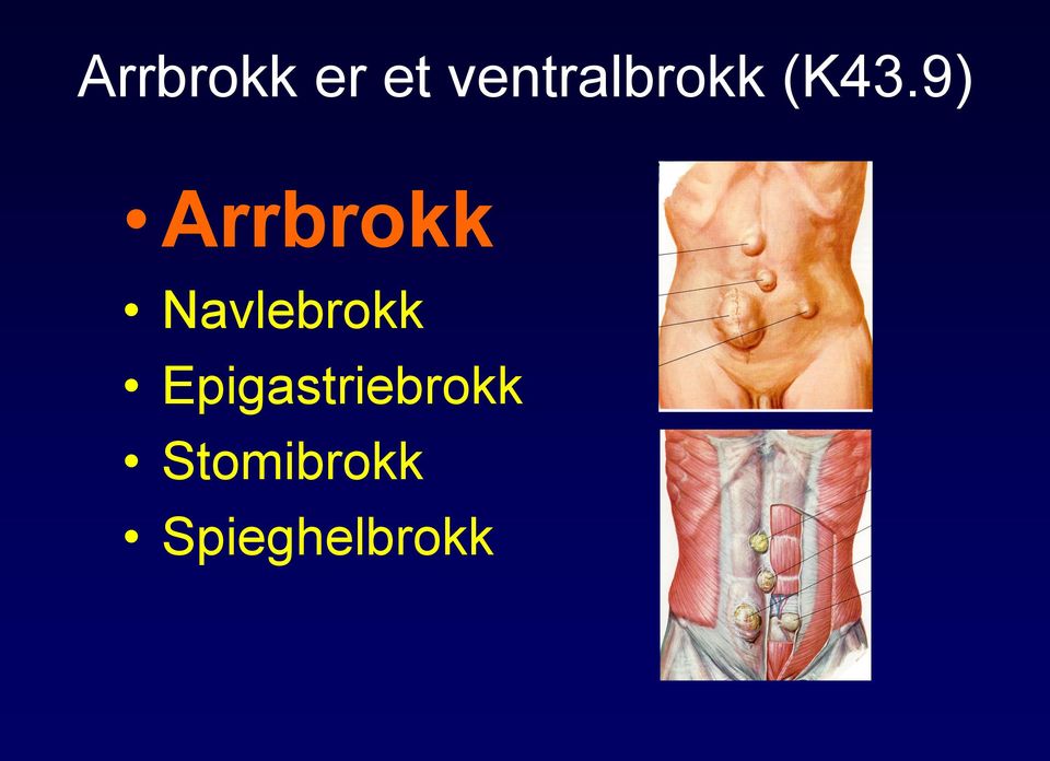 9) Arrbrokk Navlebrokk