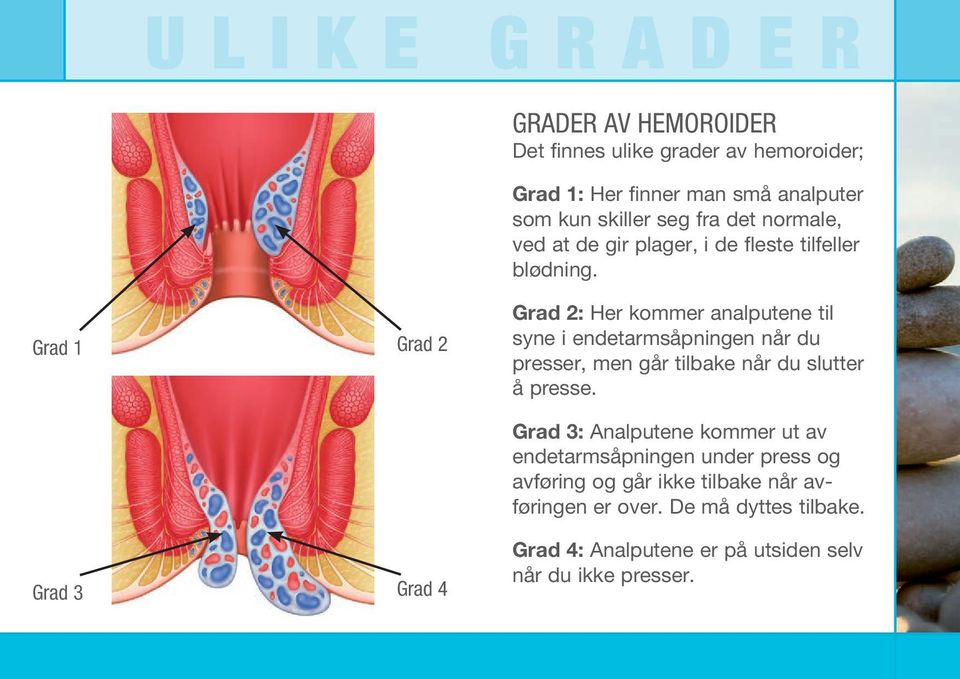 Grad 1 Grad 2 Grad 2: Her kommer analputene til syne i endetarmsåpningen når du presser, men går tilbake når du slutter å presse.