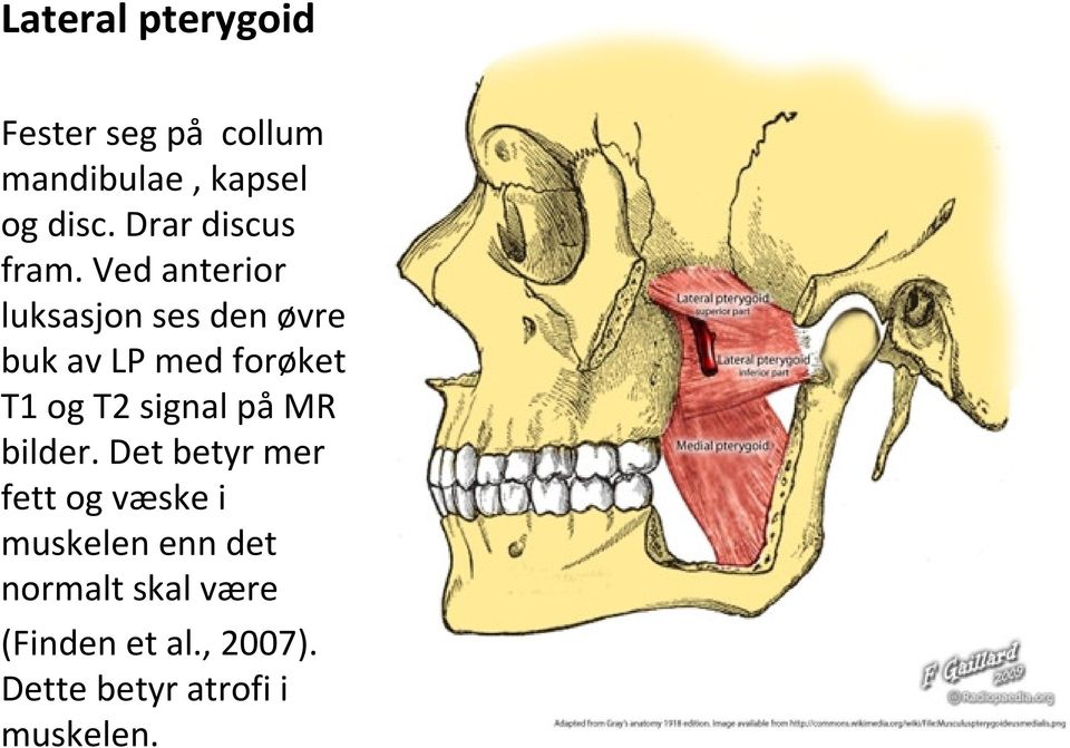 Ved anterior luksasjon ses den øvre buk av LP med forøket T1 og T2