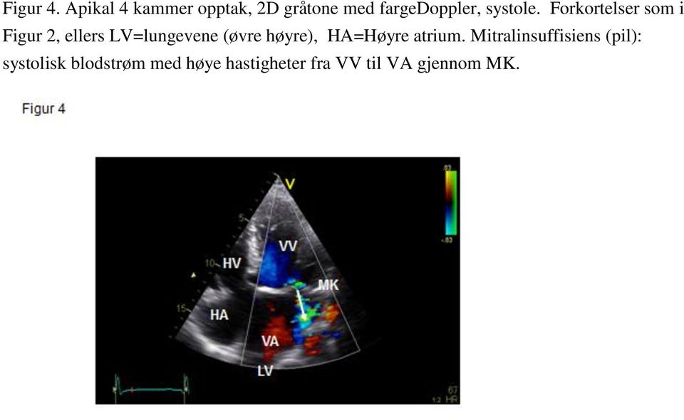 Forkortelser som i Figur 2, ellers LV=lungevene (øvre