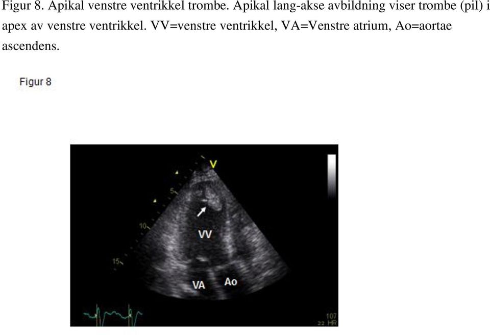 (pil) i apex av venstre ventrikkel.