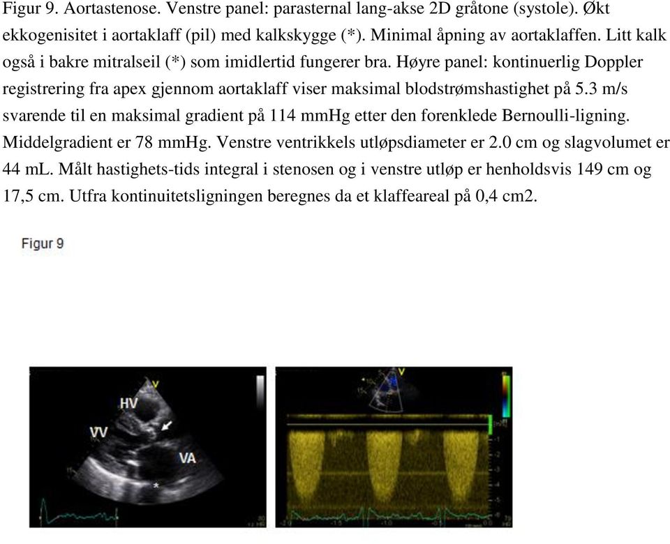 Høyre panel: kontinuerlig Doppler registrering fra apex gjennom aortaklaff viser maksimal blodstrømshastighet på 5.