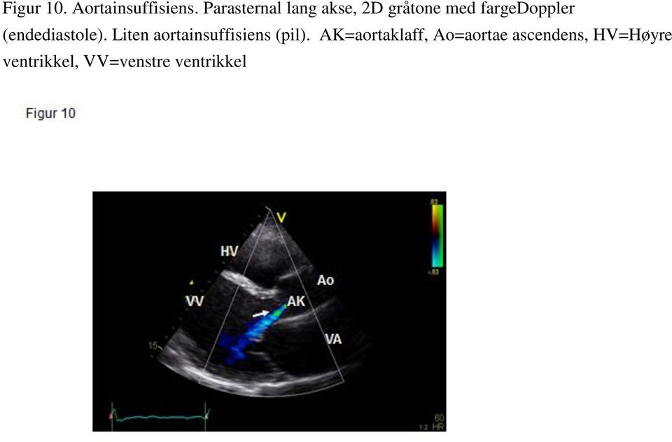 (endediastole). Liten aortainsuffisiens (pil).