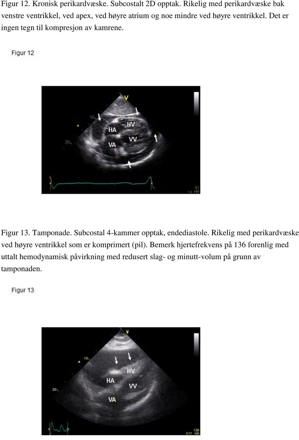 Det er ingen tegn til kompresjon av kamrene. Figur 13. Tamponade. Subcostal 4-kammer opptak, endediastole.