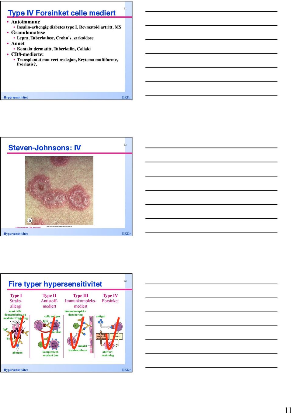 CD8-medierte: Transplantat mot vert reaksjon, Erytema multiforme, Psoriasis?, 32 Steven-Johnsons: IV! Anti-convulsant, CD8 mediated? 33 Fire typer hypersensitivitet!