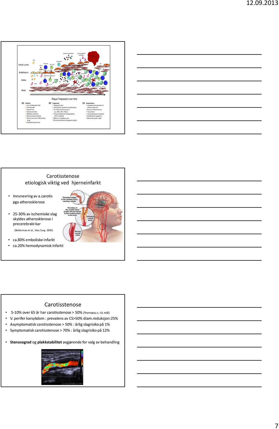 80% emboliskeinfarkt ca.20% hemodynamisk infarkt Carotisstenose 5-10% over 65 år har carotisstenose > 50% (Tromsøsu.s.-UL mål) V.