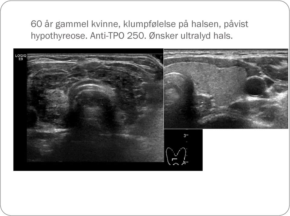 påvist hypothyreose.