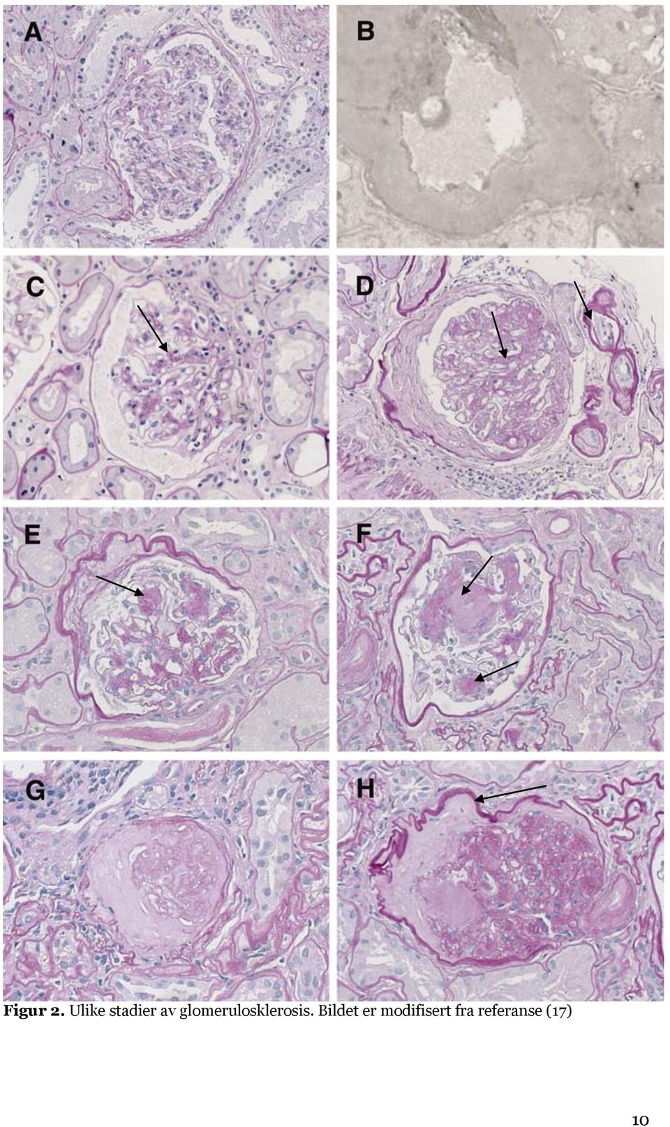 glomerulosklerosis.