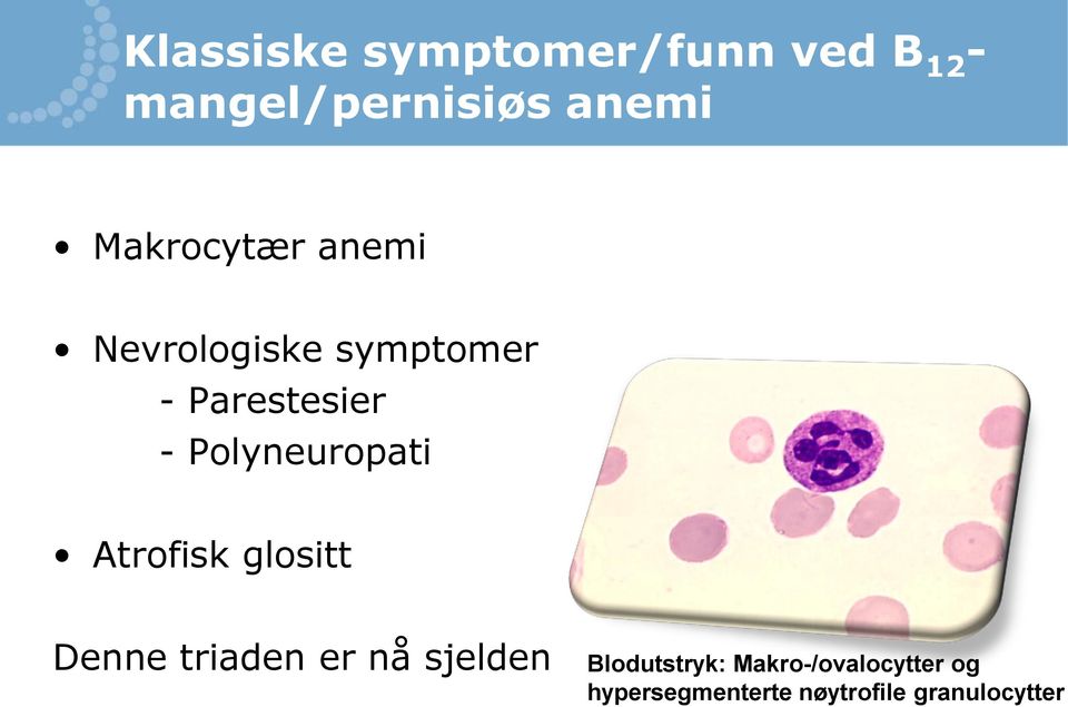 Polyneuropati Atrofisk glositt Denne triaden er nå sjelden