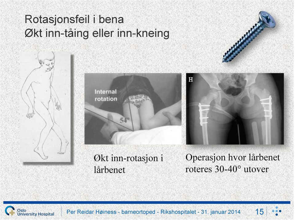 inn-rotasjon i lårbenet