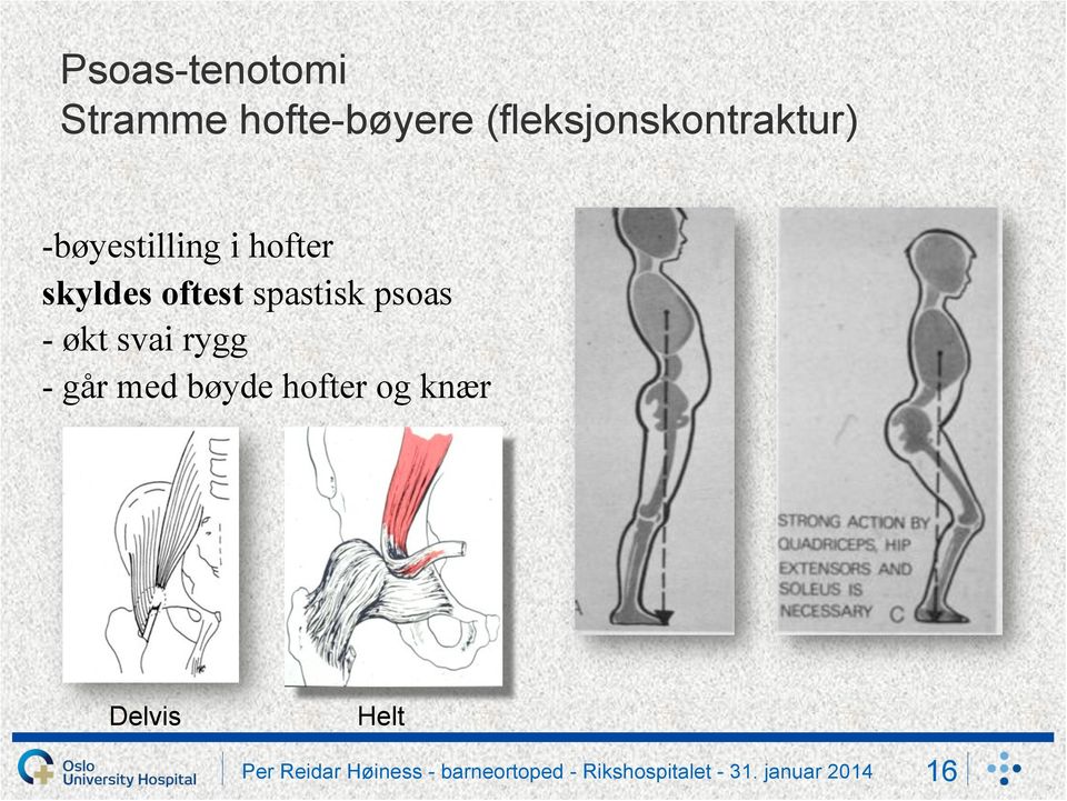 hofter skyldes oftest spastisk psoas - økt