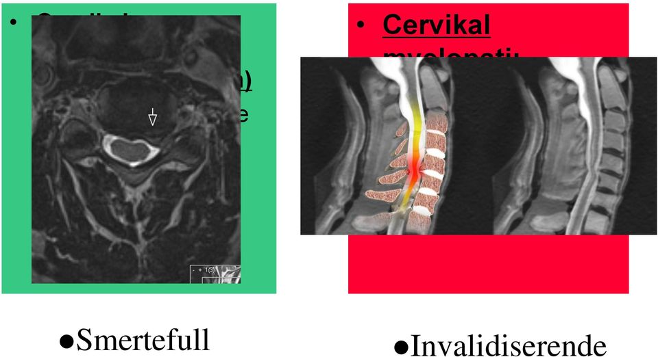 en nerverot Cervikal myelopati: (medulla-affeksjon)