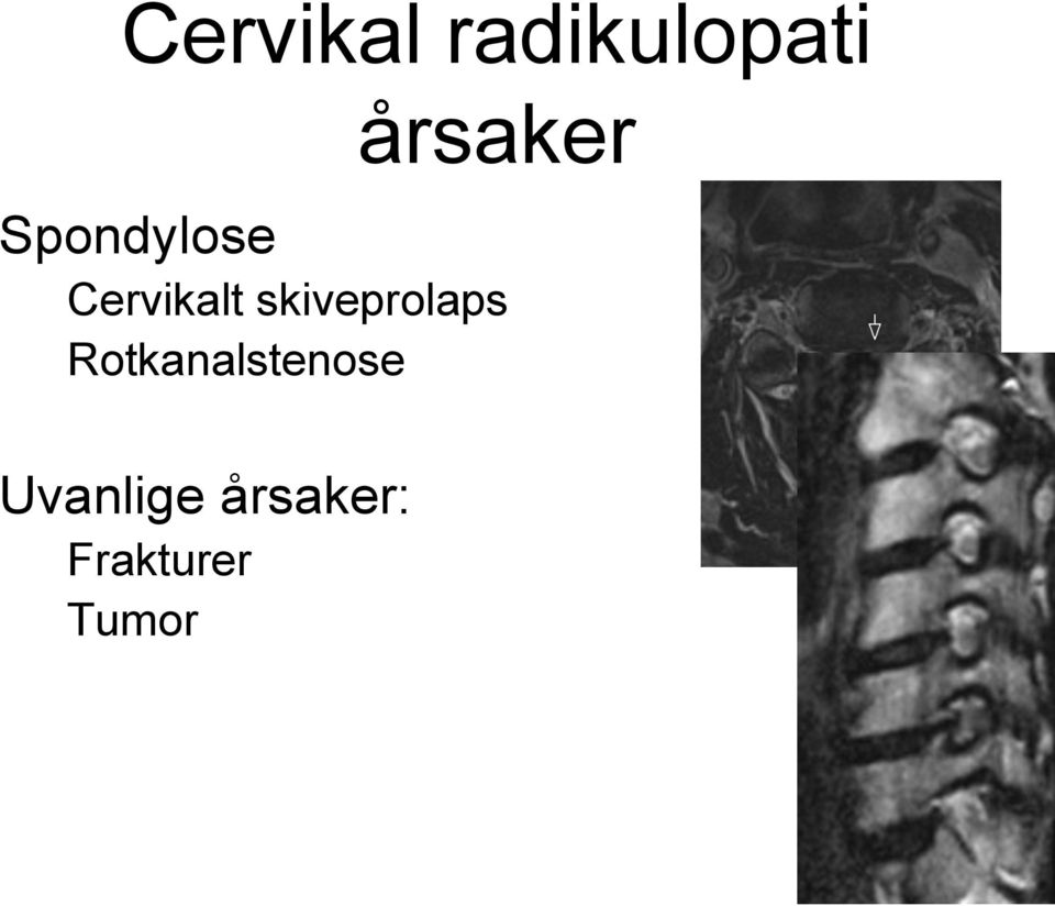 skiveprolaps Rotkanalstenose