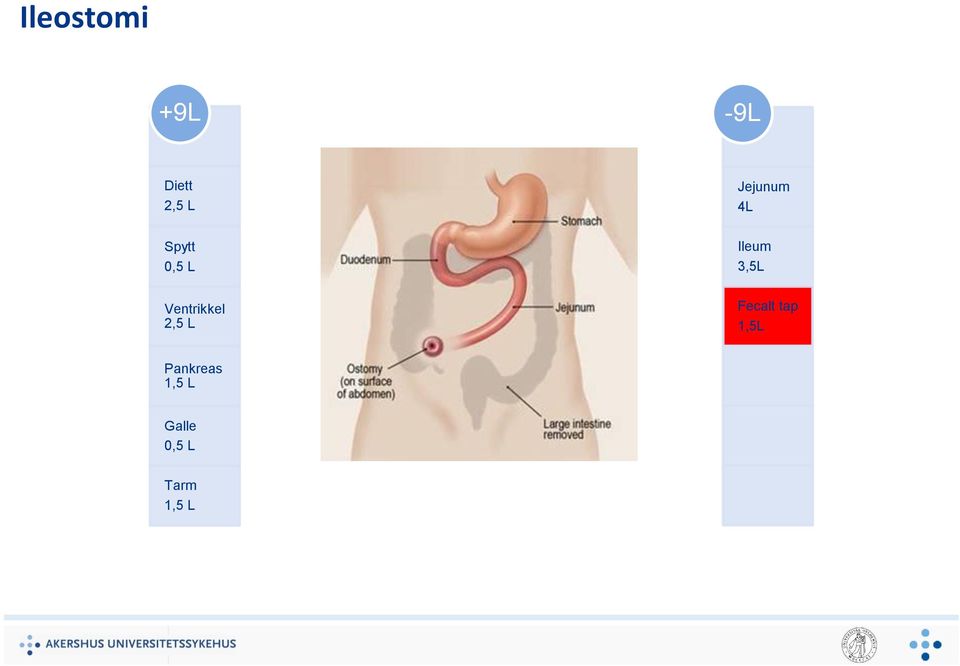 Jejunum 4L Ileum 3,5L Fecalt tap