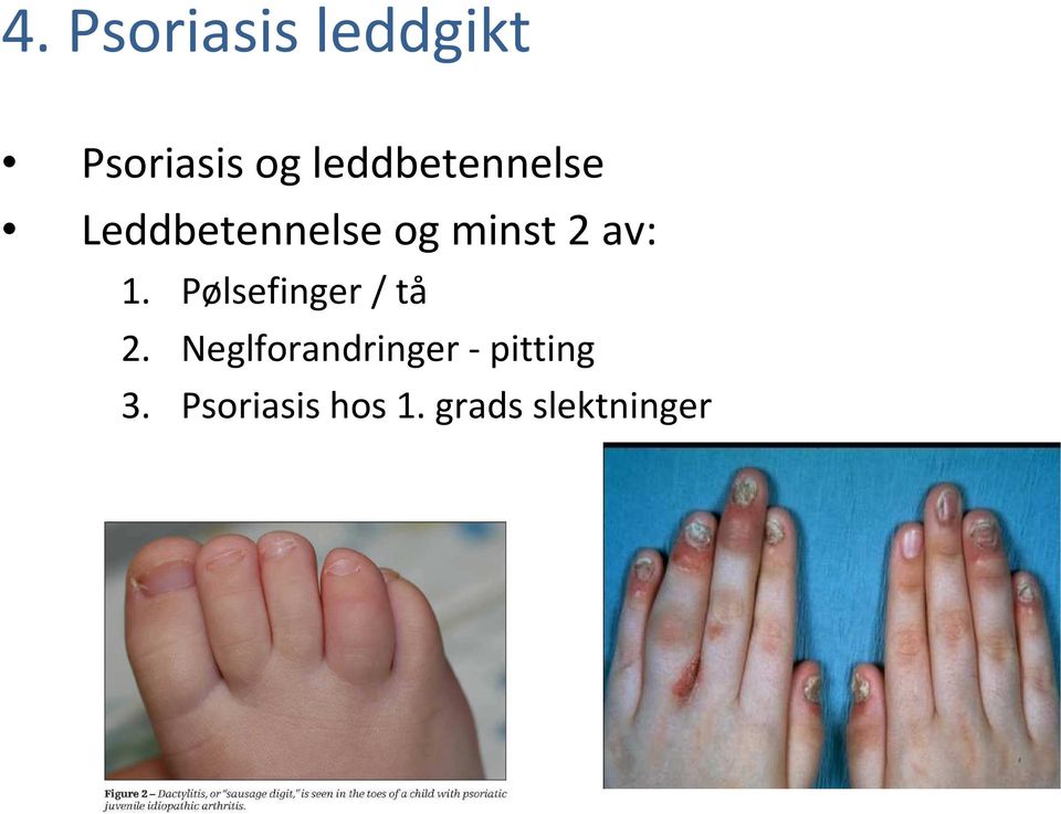 av: 1. Pølsefinger / tå 2.