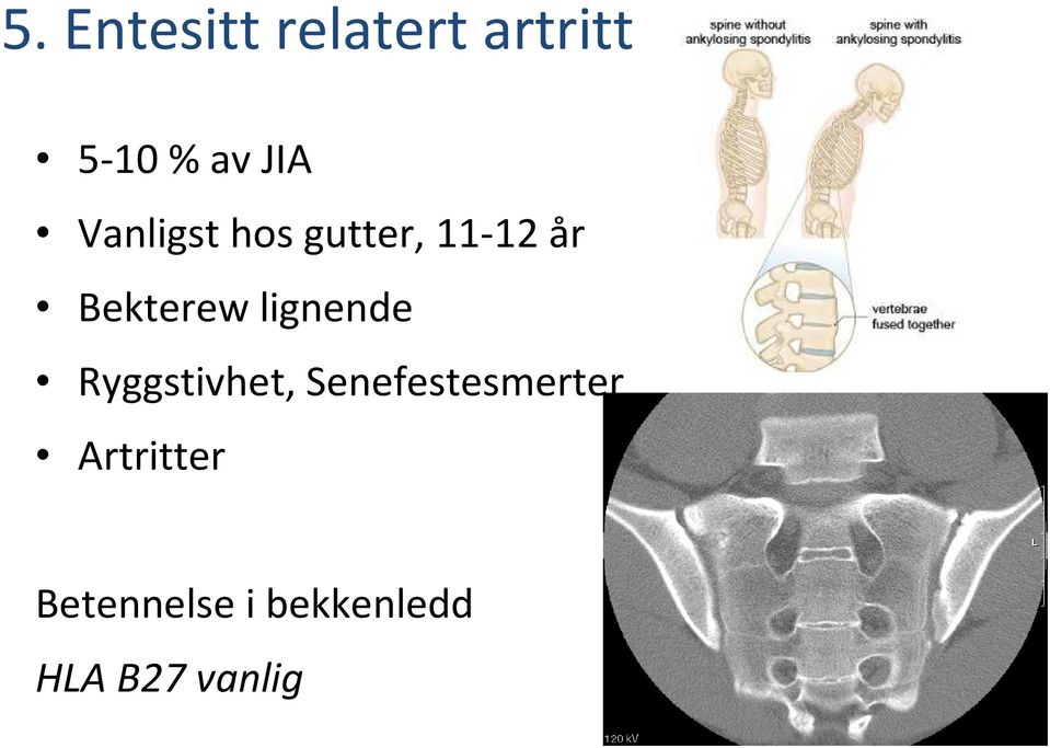 lignende Ryggstivhet, Senefestesmerter