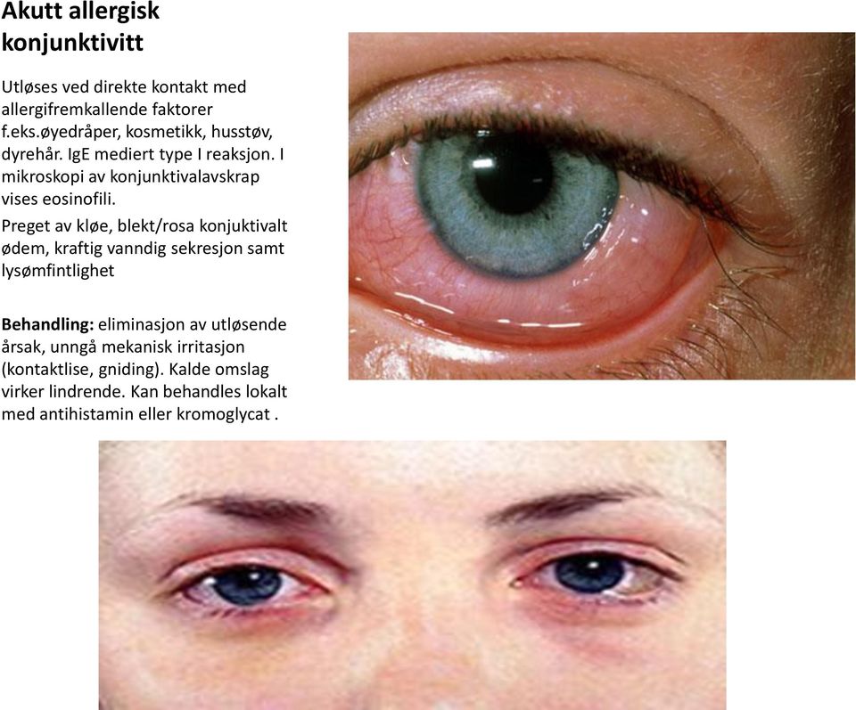 Blefaritt, konjunktivitt og andre øyesykdommer som kan behandles av  allmennlegen. Rafal Majlinger Overlege, øyeavdeling Moss - PDF Gratis  nedlasting