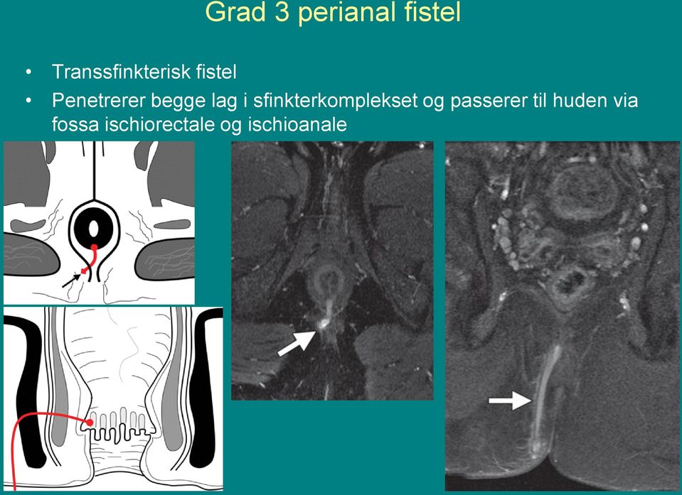 begge lag i sfinkterkomplekset og