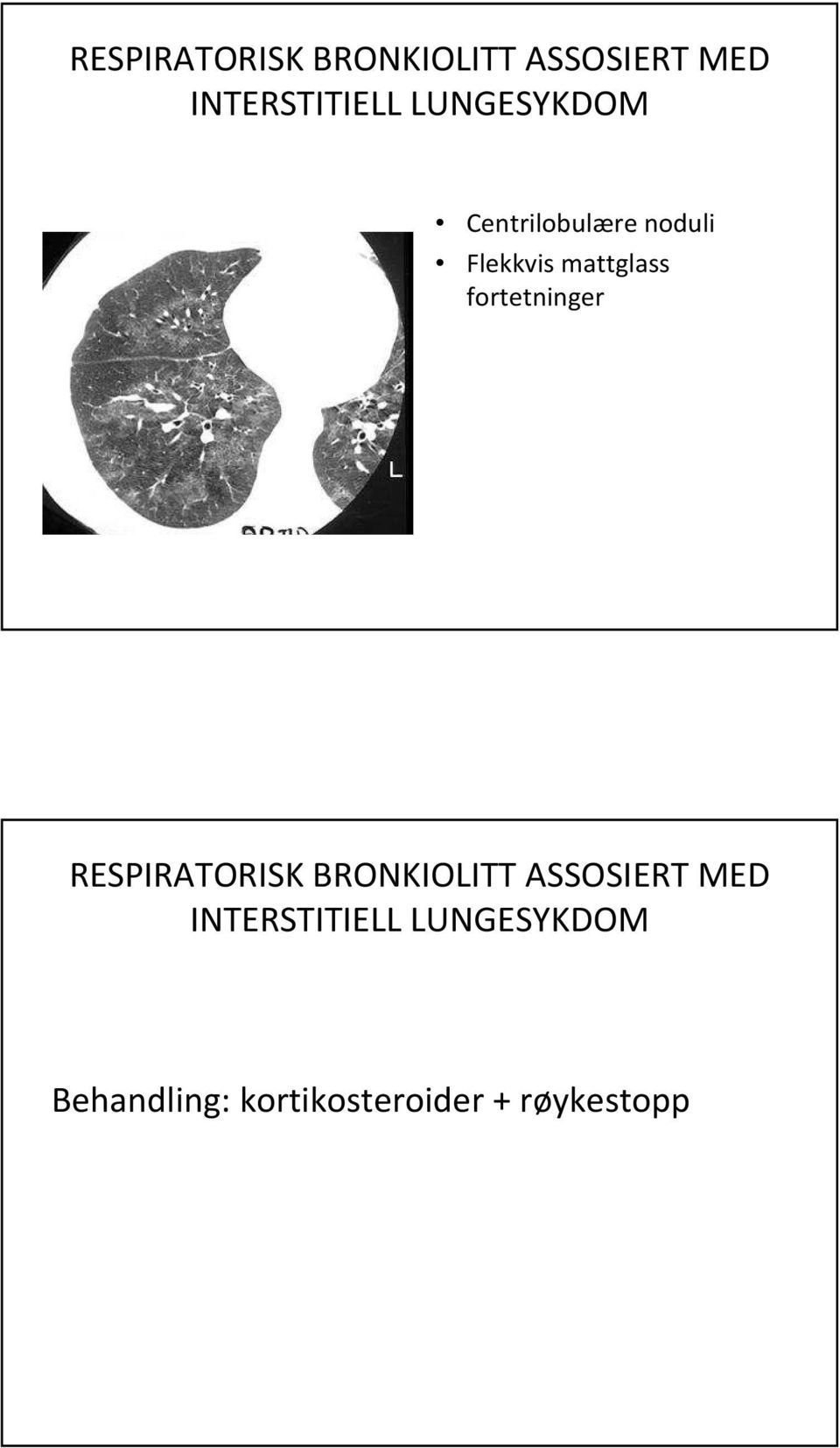 fortetninger  LUNGESYKDOM Behandling: kortikosteroider +