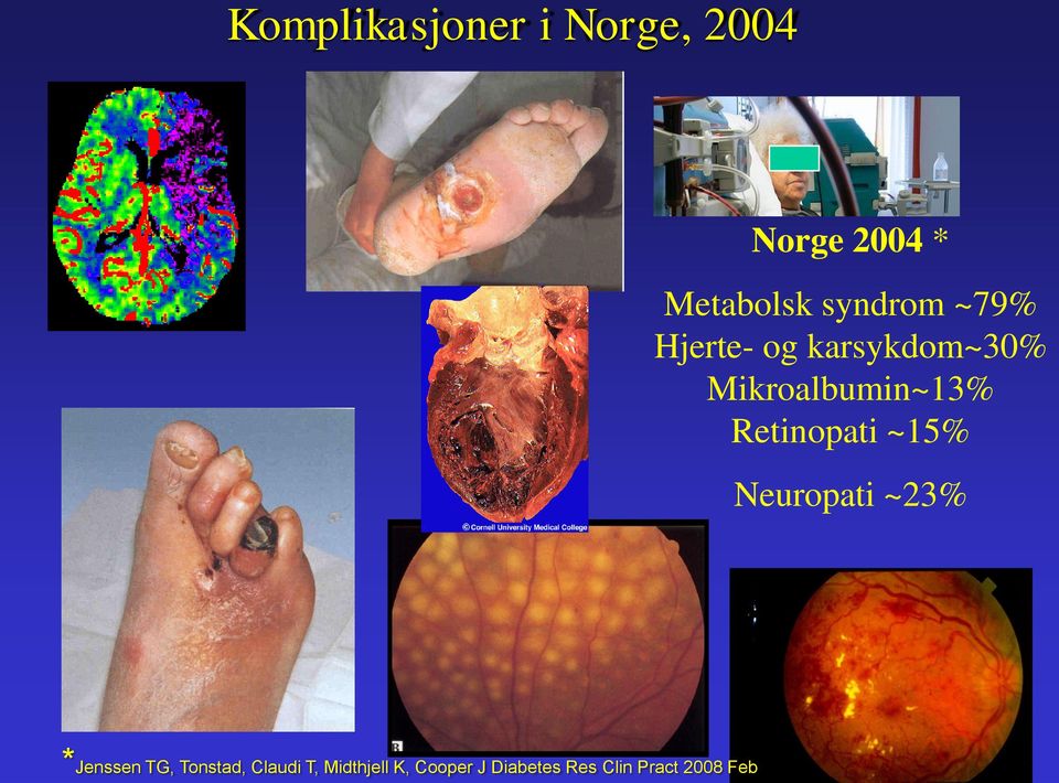 Retinopati ~15% Neuropati ~23% *Jenssen TG, Tonstad,