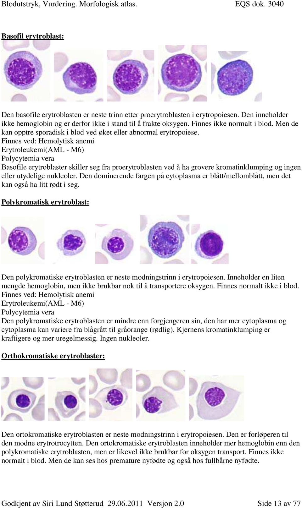 Finnes ved: Hemolytisk anemi Erytroleukemi(AML - M6) Polycytemia vera Basofile erytroblaster skiller seg fra proerytroblasten ved å ha grovere kromatinklumping og ingen eller utydelige nukleoler.